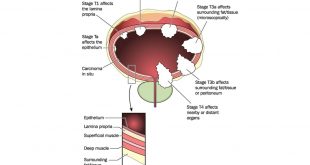 , Bladder Tumour, #Bizwhiznetwork.com Innovation &Lambda;Ｉ