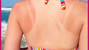 , Home Remedies to Treat Sunburn Skin Care, #Bizwhiznetwork.com Innovation ΛＩ