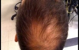 , Hair Loss Treatments In The Front and Top of Head, #Bizwhiznetwork.com Innovation ΛＩ
